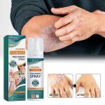 Spray pour le traitement de l'eczema et du psoriasis, spray a base de plantes pour le soulagement du ...