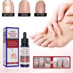 Traitement mycose ongles des pieds - 50ml - amliore lapparence des ongles fissurs