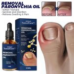 Soin des ongles incarn�s �limination des ongles paronyfriend173 traitement des ongles incarn�s meilleure ...